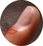 ミューカスシストの薬指の画像